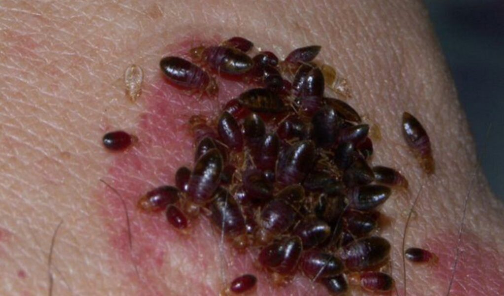 Plaga de chinches en París