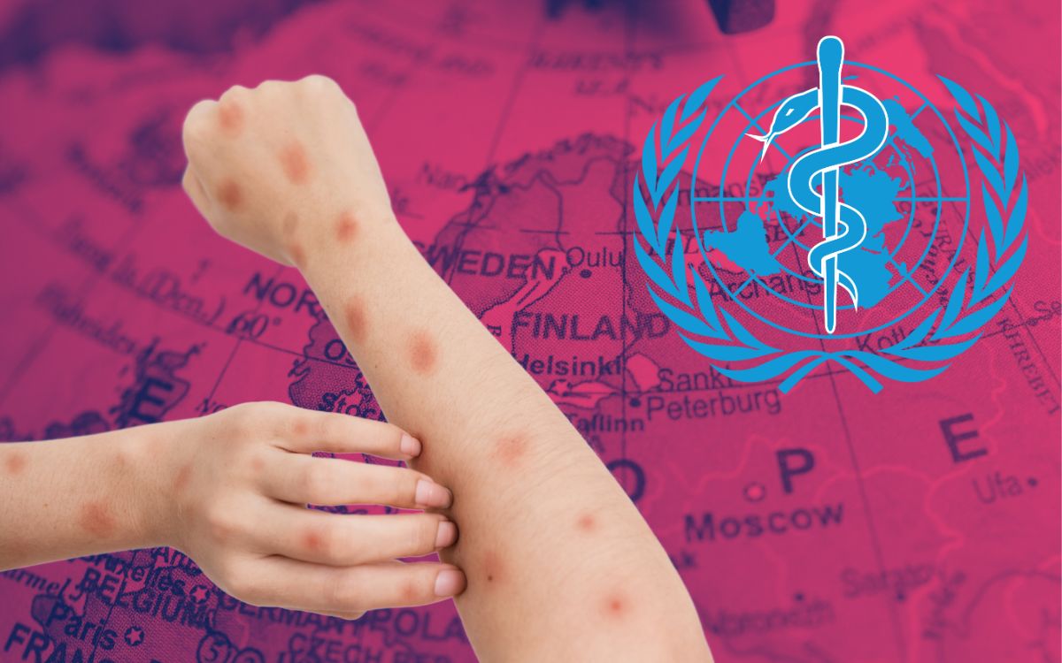 OMS asegura que sabe cómo «eliminar por completo» la transmisión de mpox en Europa